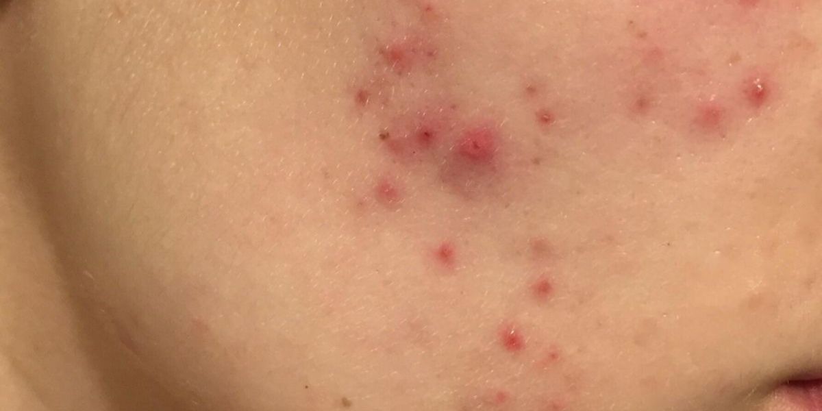 How do I treat my hormonal acne?